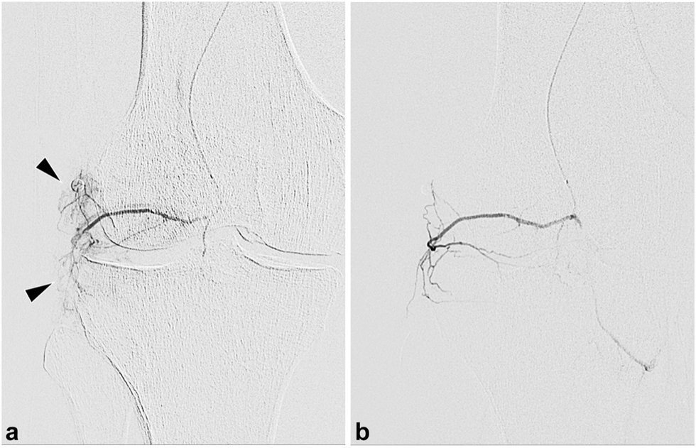 Angiograms prepost.jpg