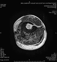 Intraosseous abscess MRI