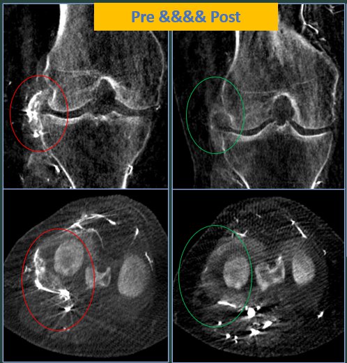 Genicular Artery Embolization As Treatment For Knee Osteoarthritis Ir Quarterly The 