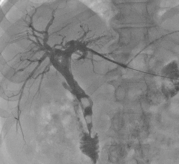 Follow-up over the wire cholangiogram status post GI stone extraction