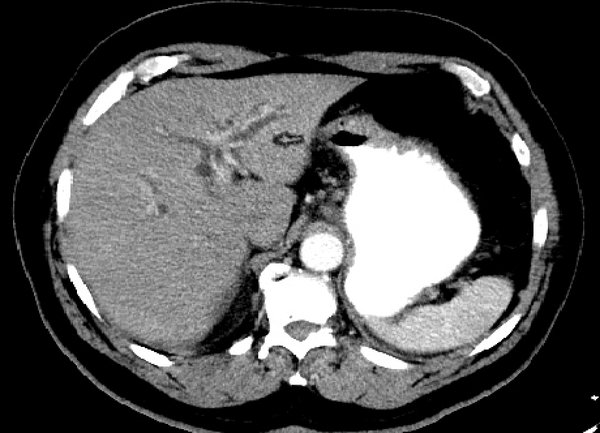 CT abdomen and pelvis revealing dilated intrahepatic bile ducts
